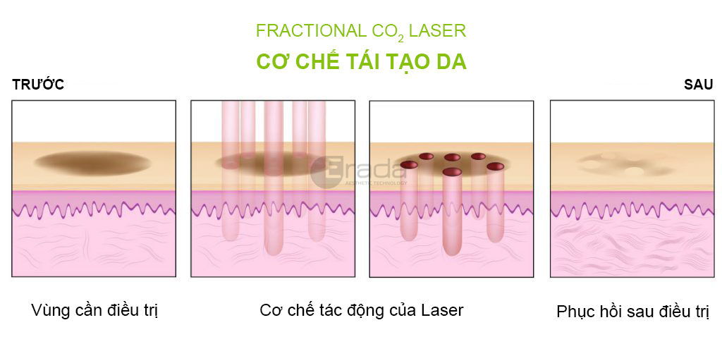 fractional-CO2-laser-cong-nghe-laser-co-che-hoat-dong