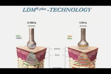 Cơ chế hoạt động của công nghệ LDM từ nhà sản xuất Wellcomet